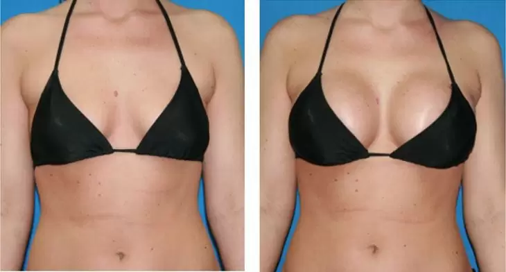 Breast Augmentation Surgery:The Best Solution for Small Breasts